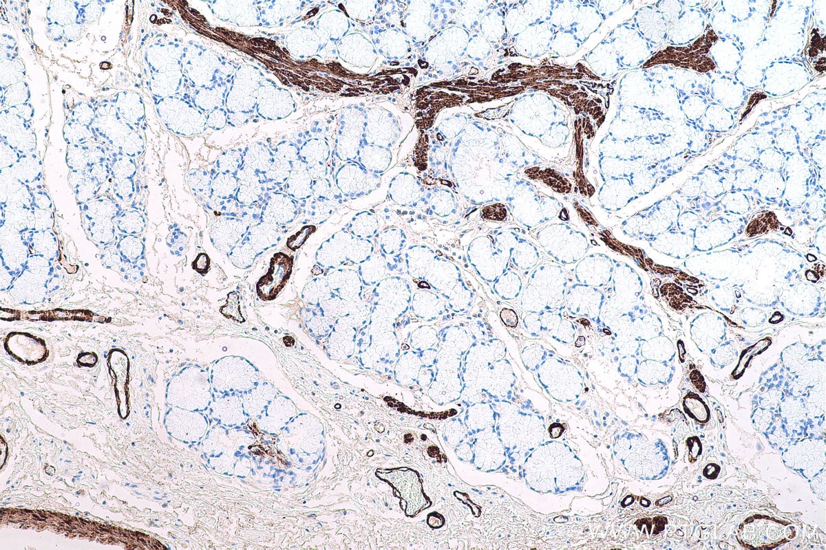 Immunohistochemical analysis of paraffin-embedded human stomach cancer tissue slide using KHC0652 (TAGLN IHC Kit).