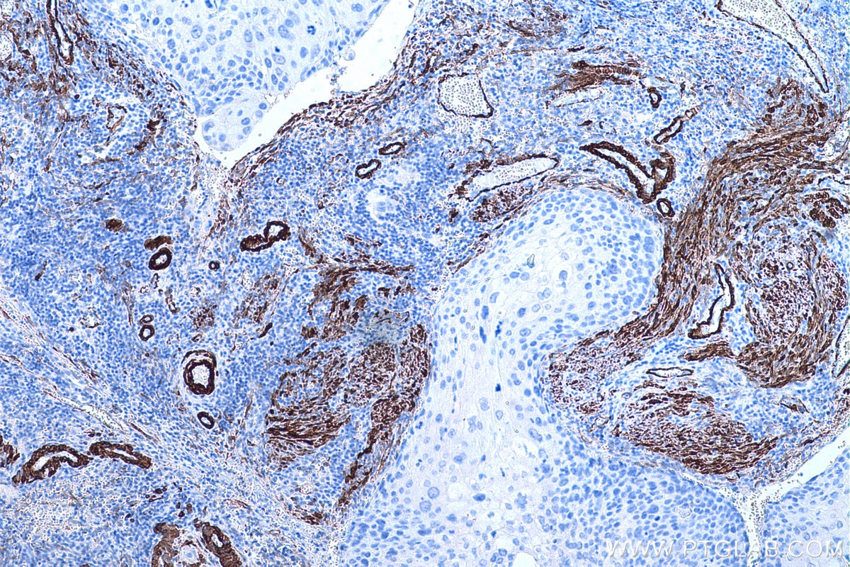 Immunohistochemical analysis of paraffin-embedded human cervical cancer tissue slide using KHC0652 (TAGLN IHC Kit).