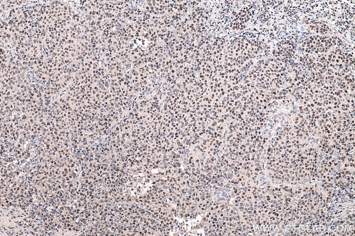 Immunohistochemical analysis of paraffin-embedded human stomach cancer tissue slide using KHC0714 (TALDO1 IHC Kit).