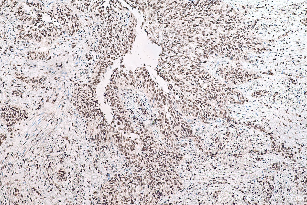 Immunohistochemical analysis of paraffin-embedded human urothelial carcinoma tissue slide using KHC0714 (TALDO1 IHC Kit).