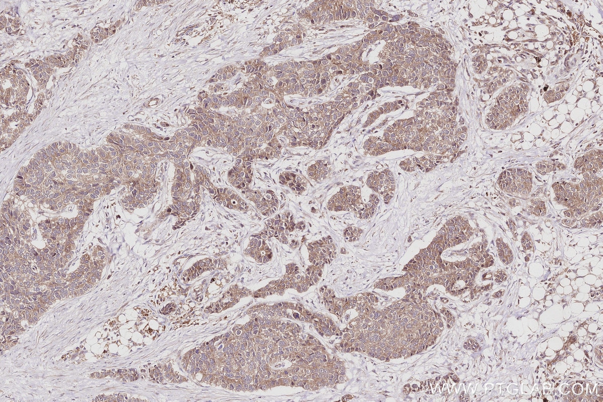 Immunohistochemical analysis of paraffin-embedded human stomach cancer tissue slide using KHC3031 (TAOK2 IHC Kit).