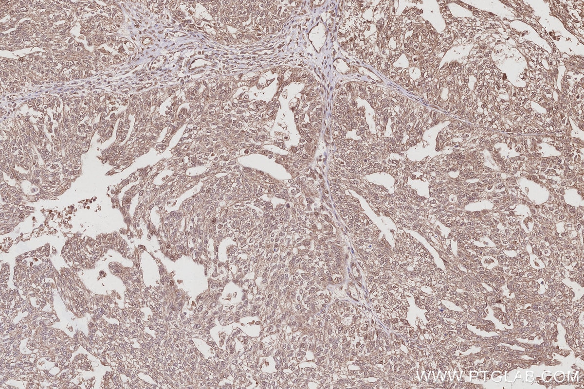 Immunohistochemical analysis of paraffin-embedded human ovary cancer tissue slide using KHC3008 (TBK1 IHC Kit).
