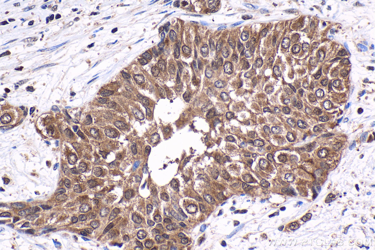 Immunohistochemical analysis of paraffin-embedded human urothelial carcinoma tissue slide using KHC1647 (TBPL1 IHC Kit).