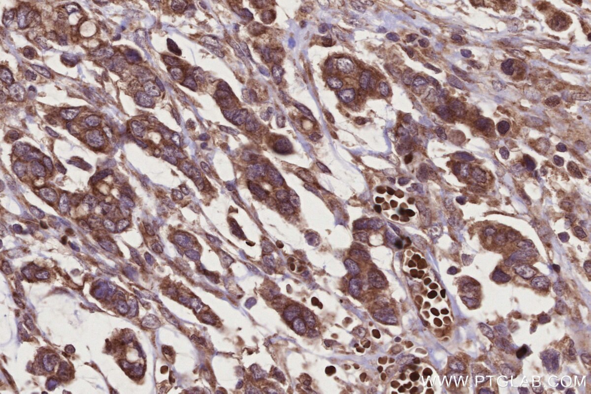 Immunohistochemical analysis of paraffin-embedded human stomach cancer tissue slide using KHC2774 (TBRG4 IHC Kit).