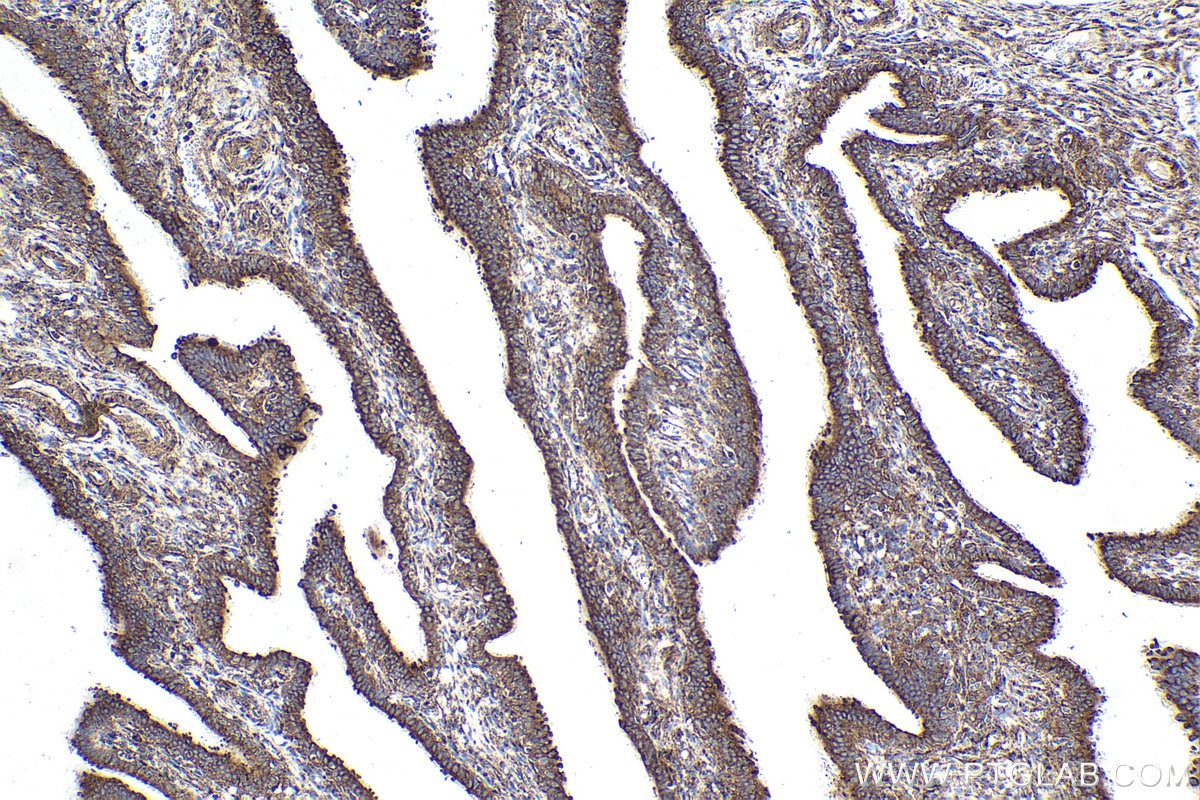 Immunohistochemical analysis of paraffin-embedded human ovary tumor tissue slide using KHC1893 (TBX5 IHC Kit).