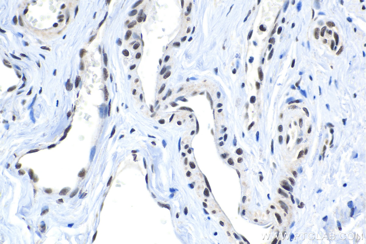 Immunohistochemical analysis of paraffin-embedded human cervical cancer tissue slide using KHC1559 (TCEA1 IHC Kit).