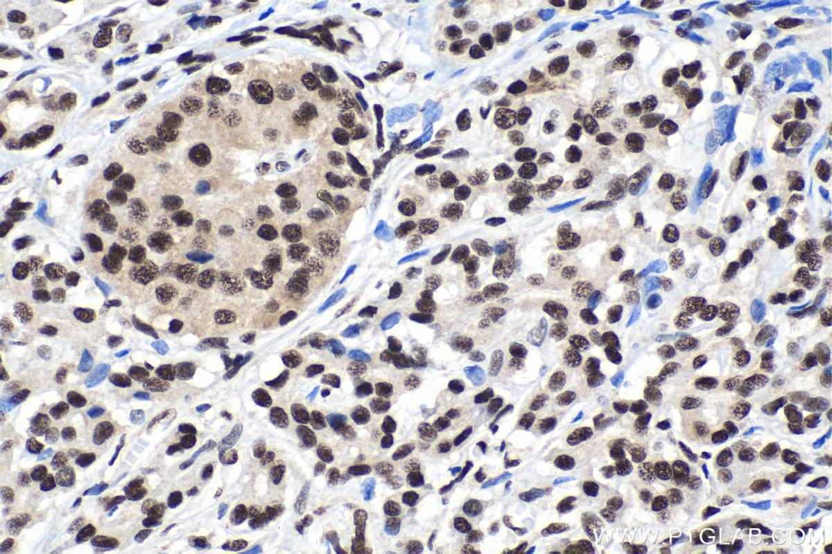 Immunohistochemical analysis of paraffin-embedded human pancreas cancer tissue slide using KHC1428 (TCERG1 IHC Kit).