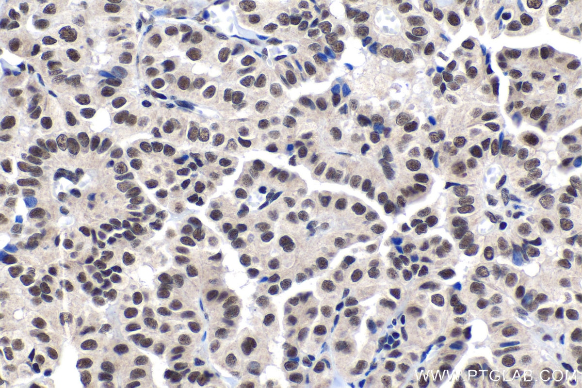 Immunohistochemical analysis of paraffin-embedded human thyroid cancer tissue slide using KHC1428 (TCERG1 IHC Kit).