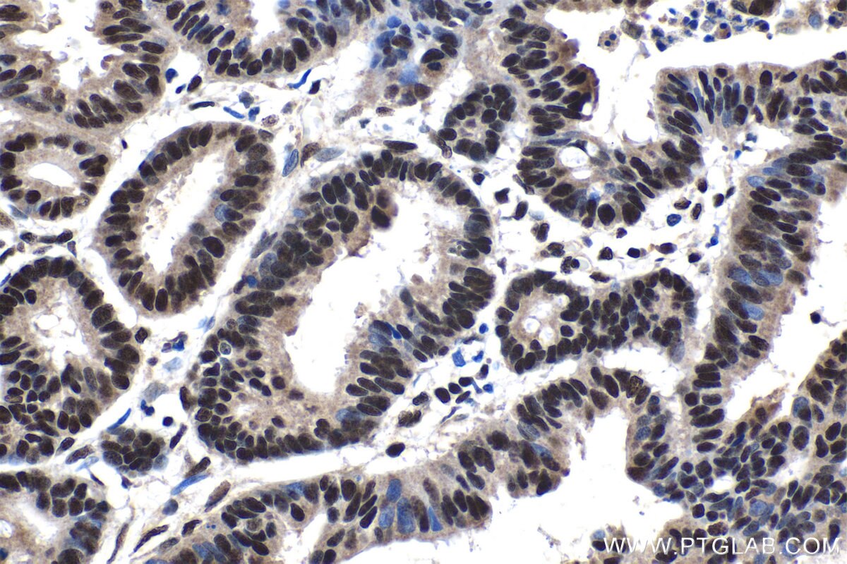 Immunohistochemical analysis of paraffin-embedded human urothelial carcinoma tissue slide using KHC1428 (TCERG1 IHC Kit).
