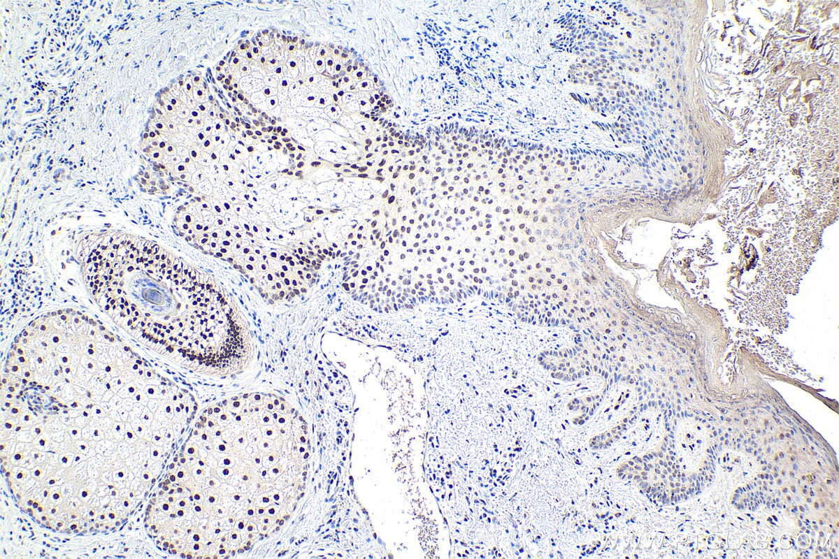 Immunohistochemical analysis of paraffin-embedded human skin cancer tissue slide using KHC1888 (TCF12 IHC Kit).