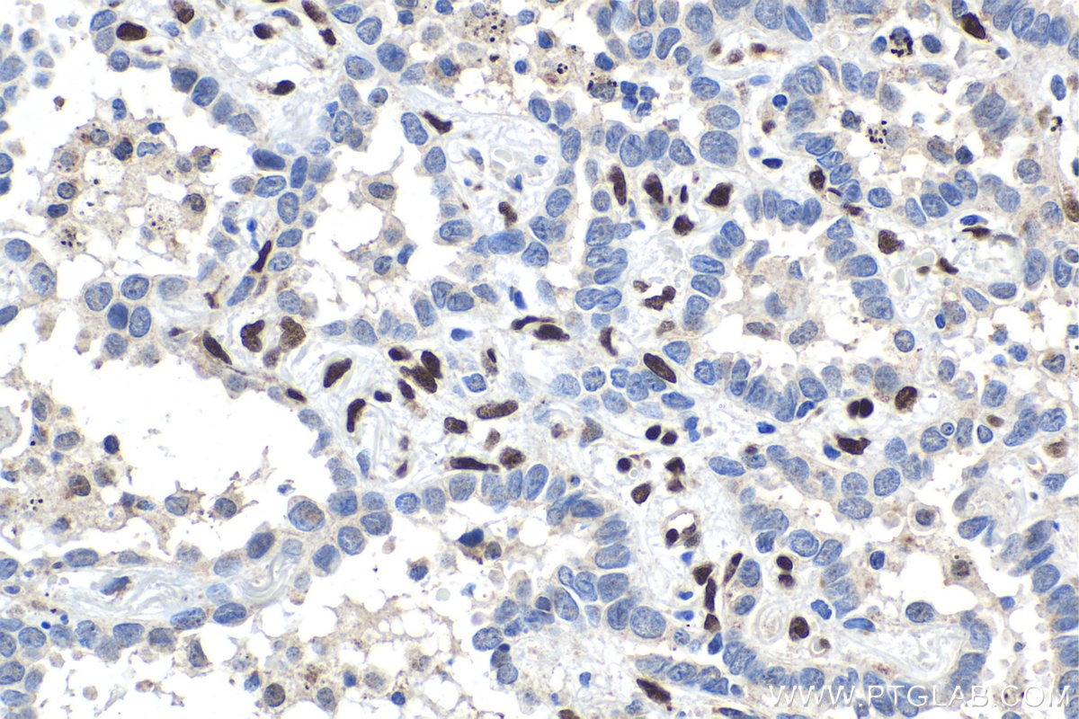 Immunohistochemical analysis of paraffin-embedded human lung cancer tissue slide using KHC1536 (TCF4 IHC Kit).