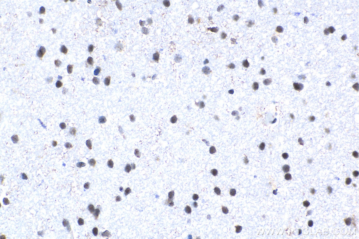 Immunohistochemical analysis of paraffin-embedded human gliomas tissue slide using KHC1536 (TCF4 IHC Kit).