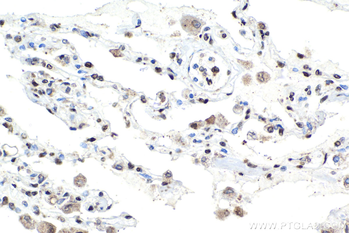 Immunohistochemical analysis of paraffin-embedded human lung cancer tissue slide using KHC1958 (TCF4/TCF7L2 IHC Kit).