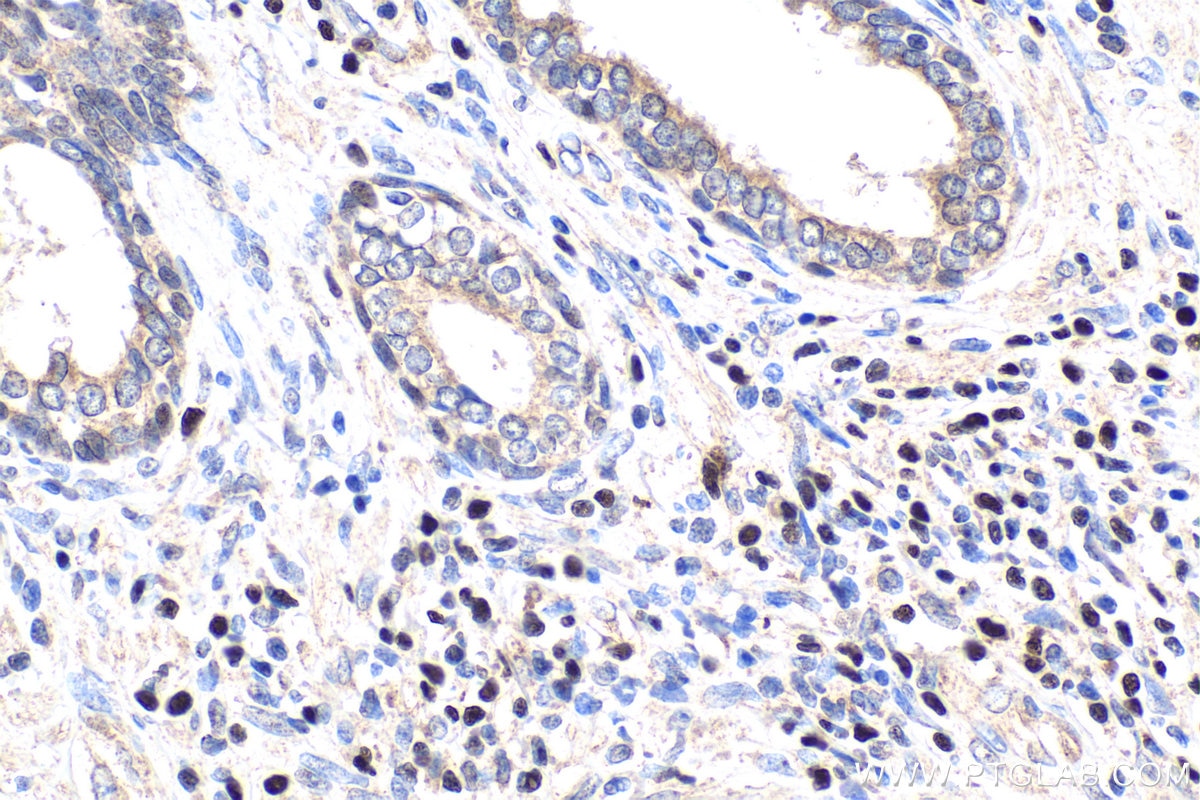 Immunohistochemical analysis of paraffin-embedded human prostate cancer tissue slide using KHC1599 (TCF7 IHC Kit).
