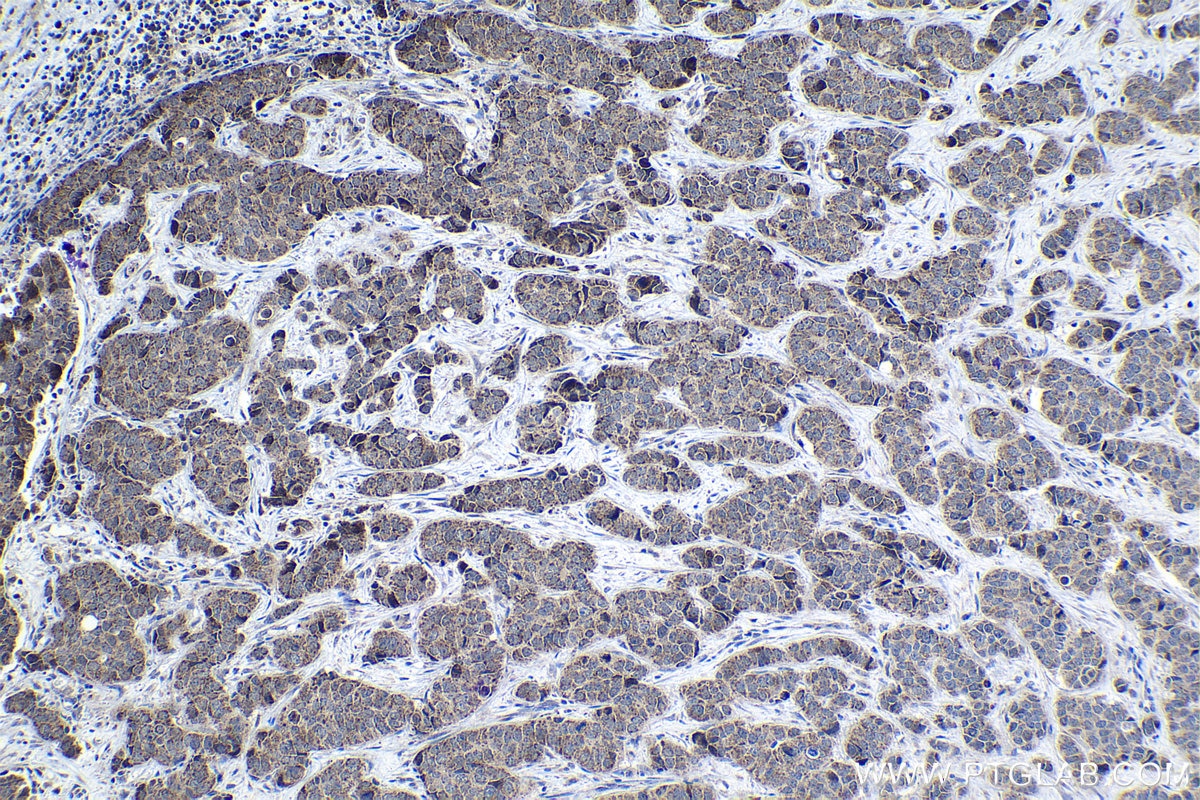 Immunohistochemical analysis of paraffin-embedded human breast cancer tissue slide using KHC1347 (TCL1A IHC Kit).