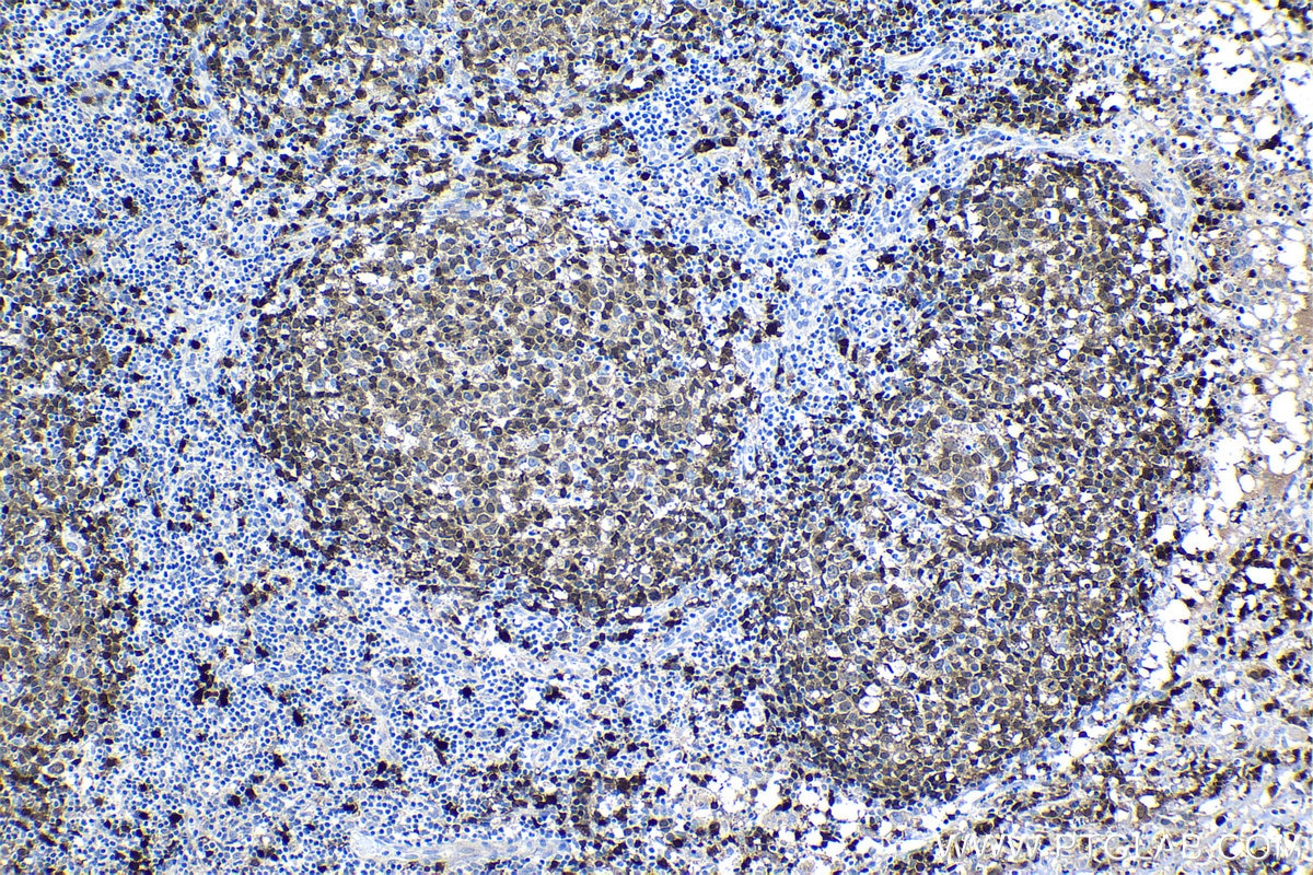 Immunohistochemical analysis of paraffin-embedded human lymphoma tissue slide using KHC1347 (TCL1A IHC Kit).