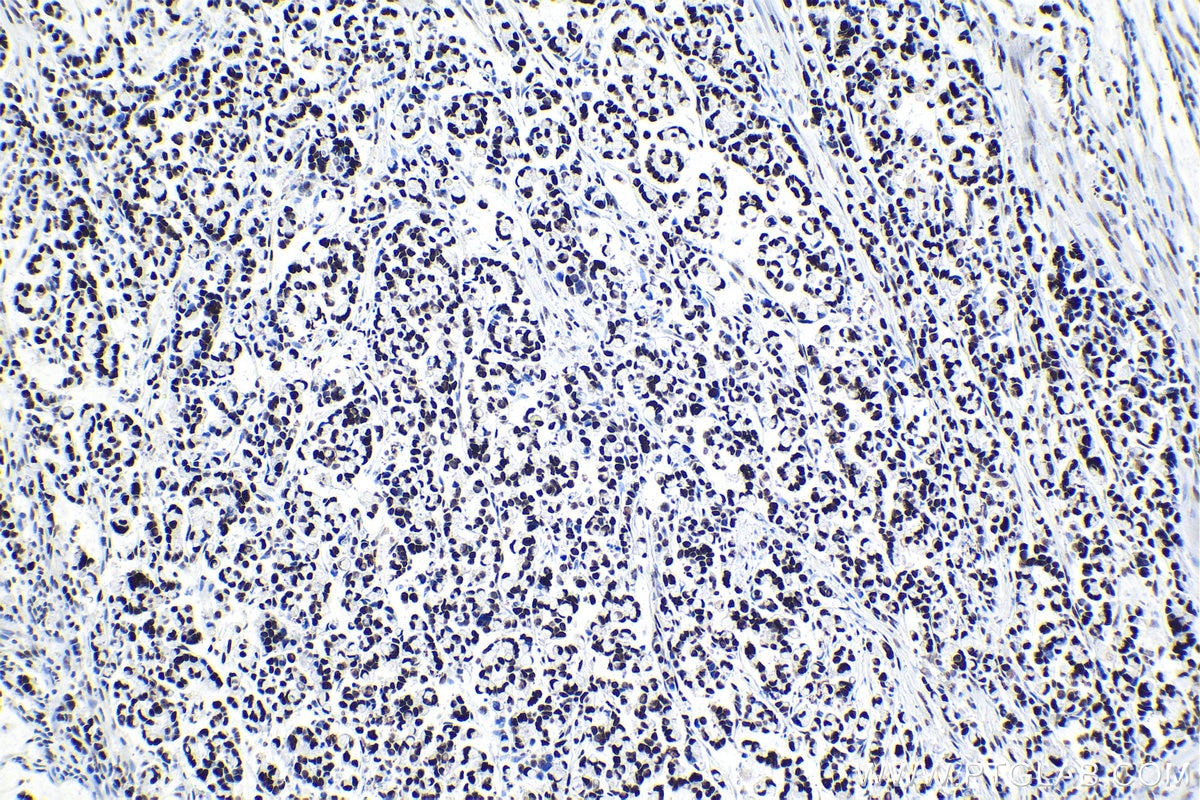 Immunohistochemical analysis of paraffin-embedded human colon cancer tissue slide using KHC1017 (TCOF1 IHC Kit).