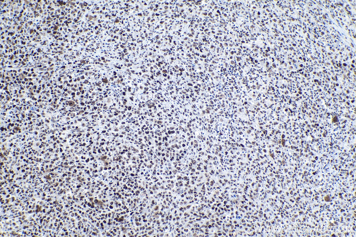 Immunohistochemical analysis of paraffin-embedded human lymphoma tissue slide using KHC1017 (TCOF1 IHC Kit).