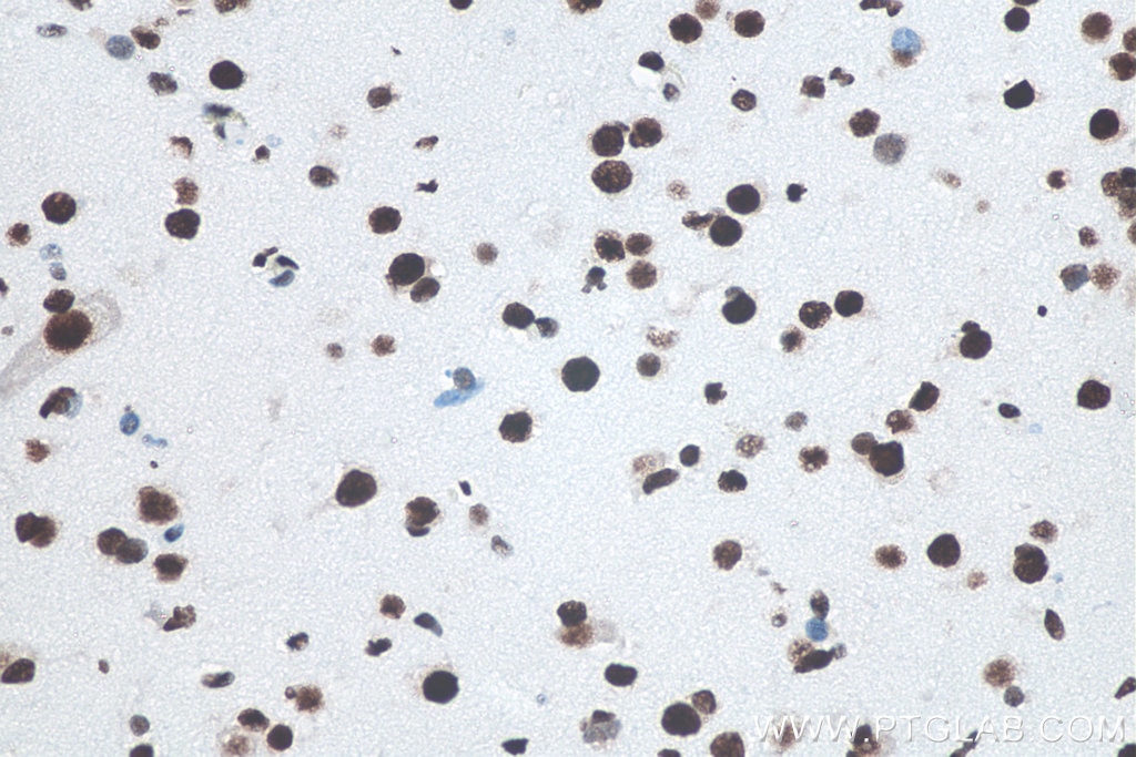 Immunohistochemical analysis of paraffin-embedded human gliomas tissue slide using KHC0001 (TDP-43 IHC Kit).