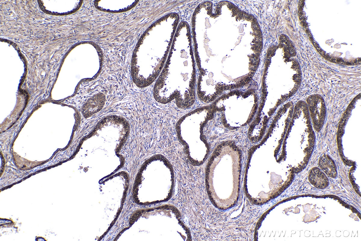 Immunohistochemical analysis of paraffin-embedded human prostate cancer tissue slide using KHC1495 (TDP2 IHC Kit).