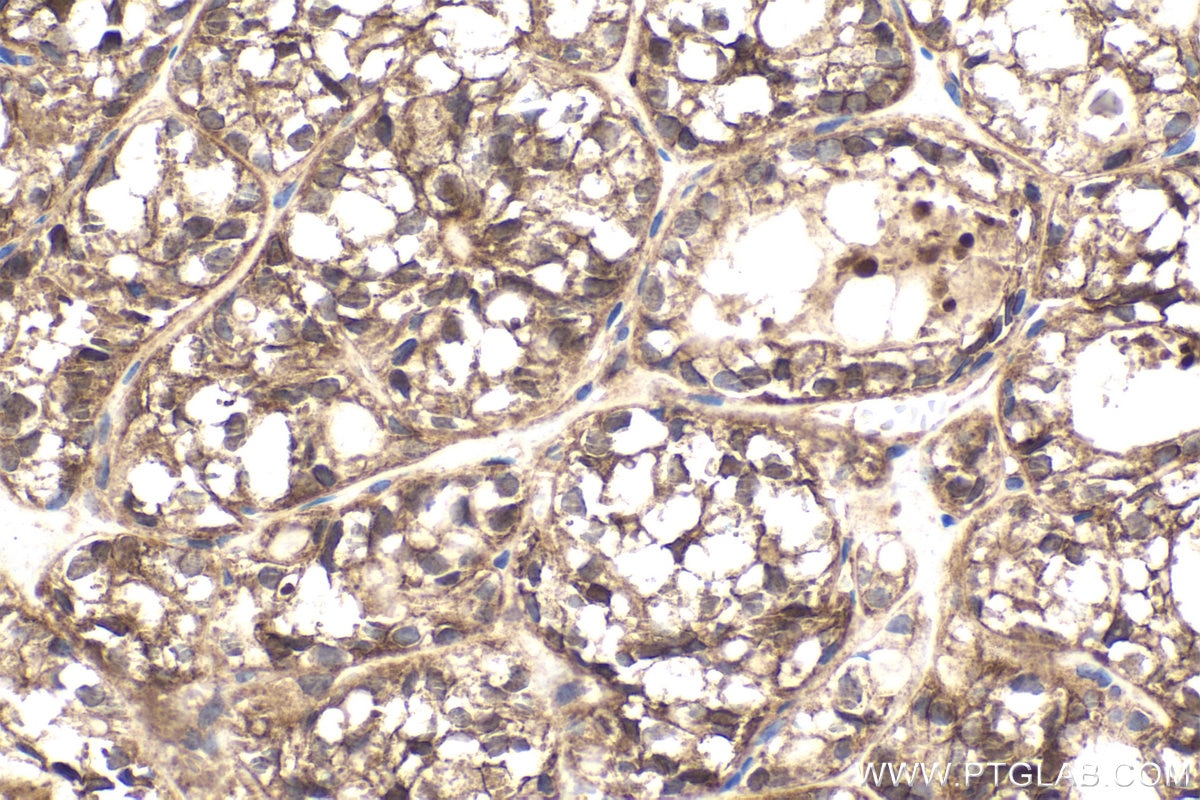 Immunohistochemical analysis of paraffin-embedded human thyroid cancer tissue slide using KHC1869 (TESC IHC Kit).