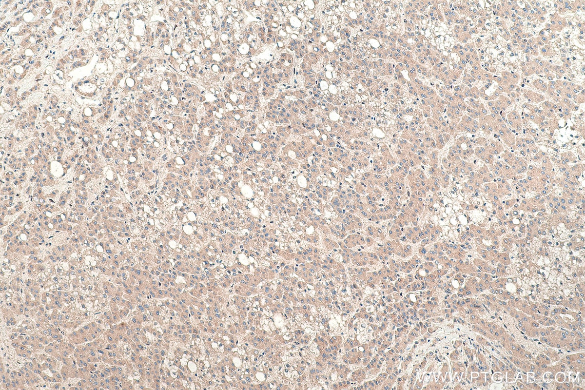 Immunohistochemical analysis of paraffin-embedded human liver cancer tissue slide using KHC0377 (TF IHC Kit).