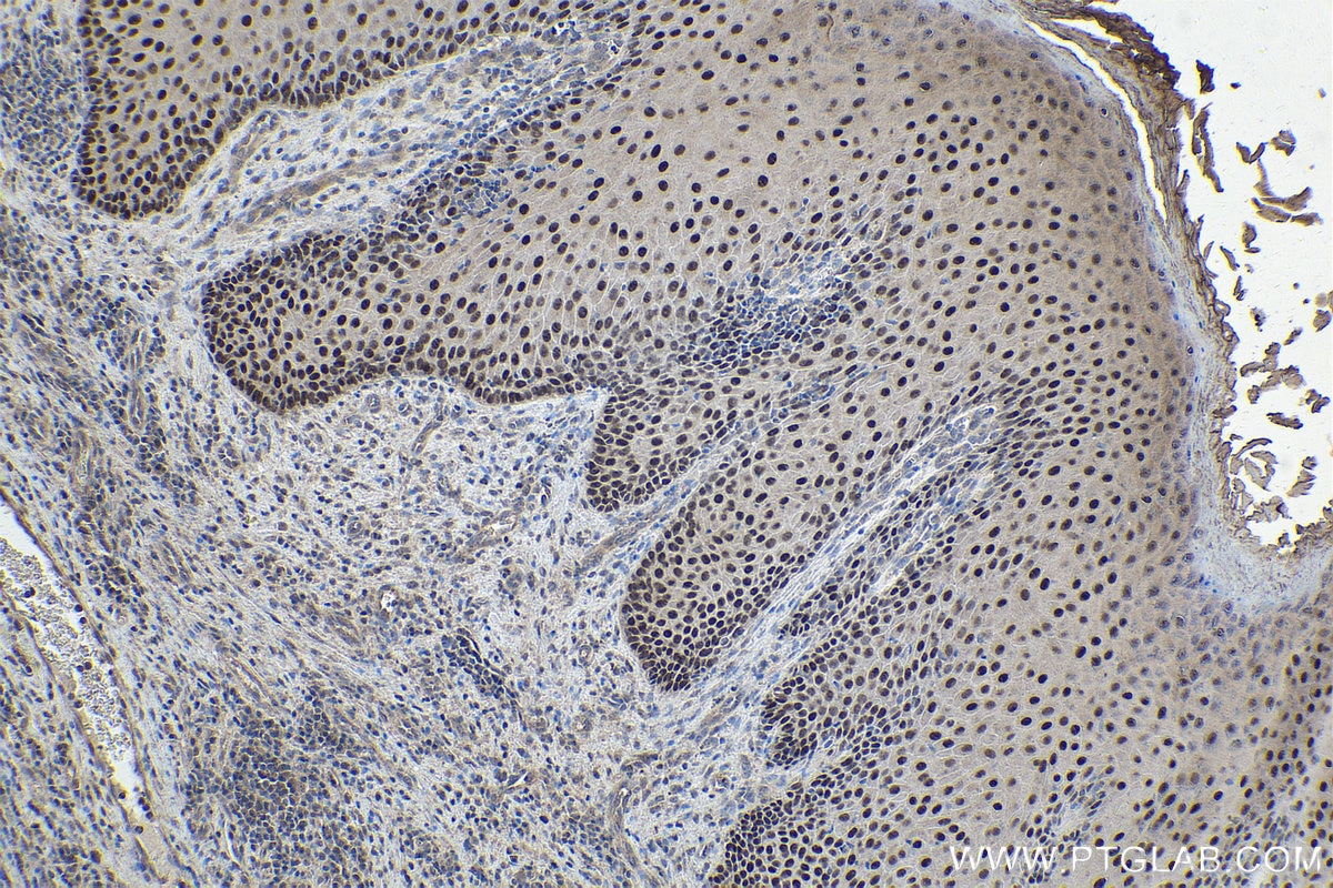 Immunohistochemical analysis of paraffin-embedded human skin cancer tissue slide using KHC1852 (TFAP2C IHC Kit).