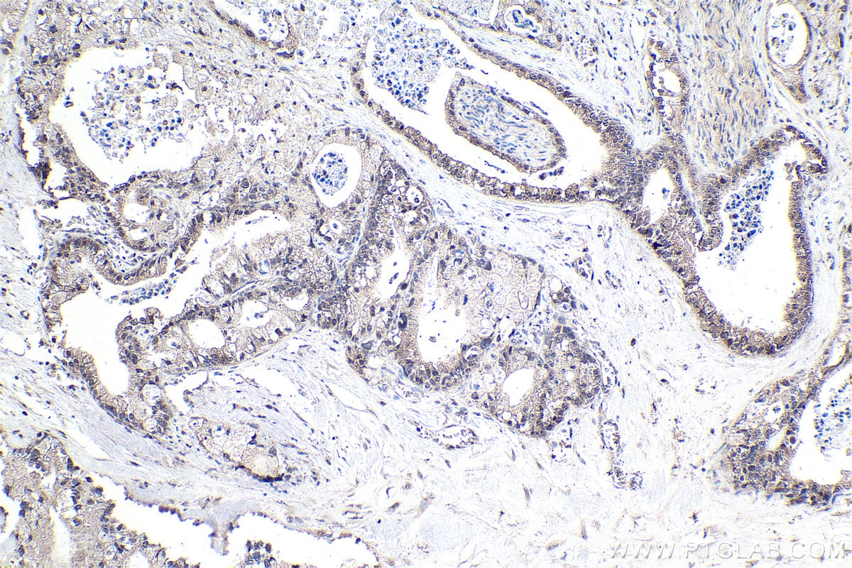 Immunohistochemical analysis of paraffin-embedded human pancreas cancer tissue slide using KHC1726 (TFDP1 IHC Kit).