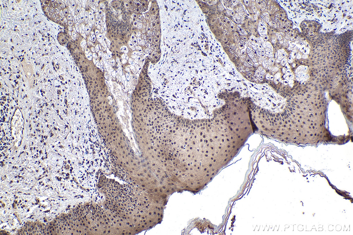 Immunohistochemical analysis of paraffin-embedded human skin cancer tissue slide using KHC1726 (TFDP1 IHC Kit).