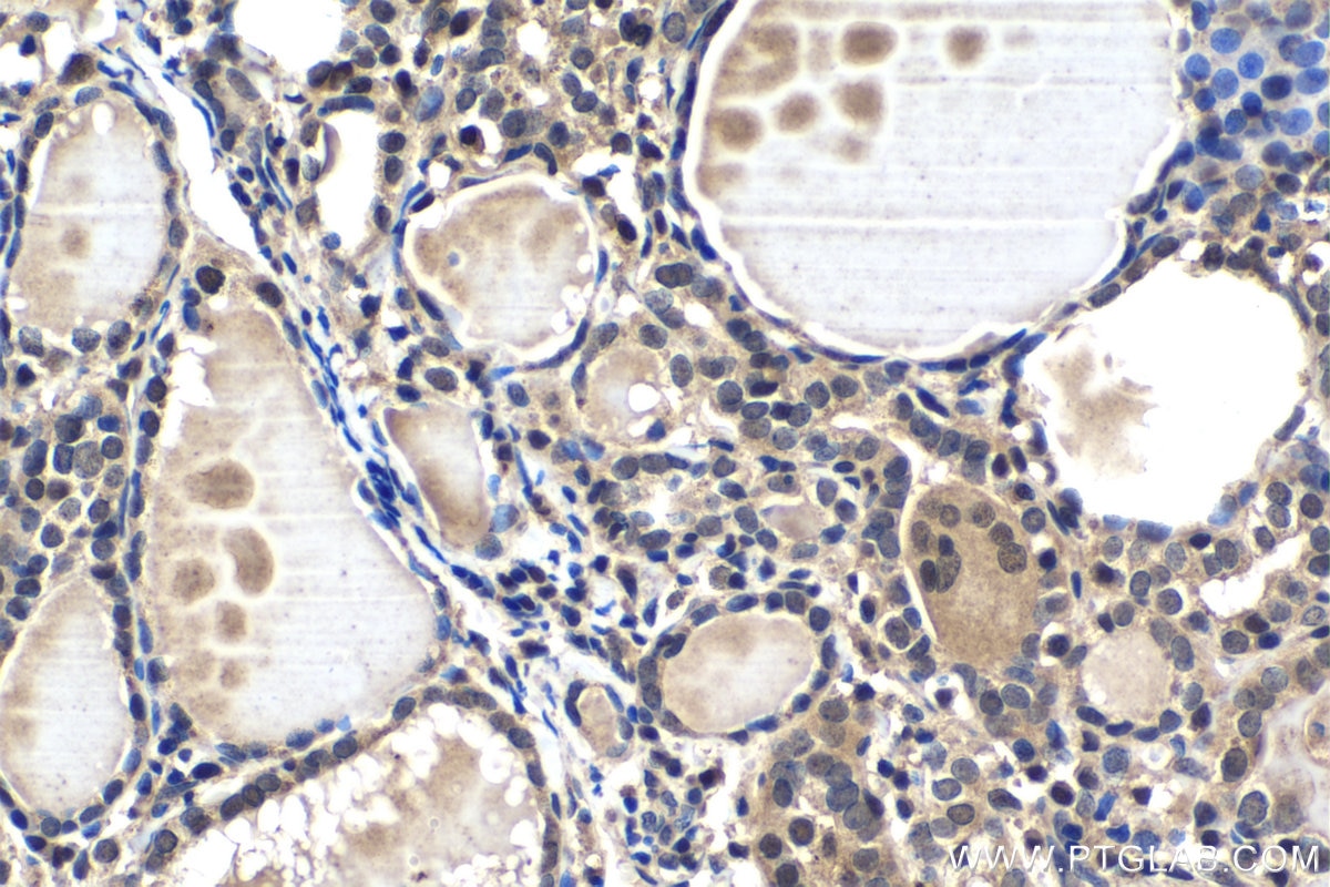 Immunohistochemical analysis of paraffin-embedded human thyroid cancer tissue slide using KHC1547 (TFE3 IHC Kit).