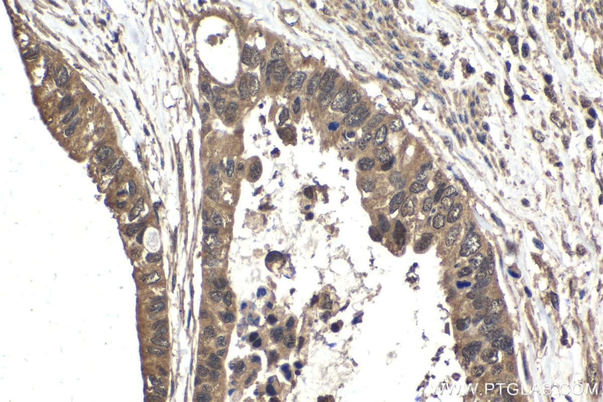 Immunohistochemical analysis of paraffin-embedded human urothelial carcinoma tissue slide using KHC1547 (TFE3 IHC Kit).
