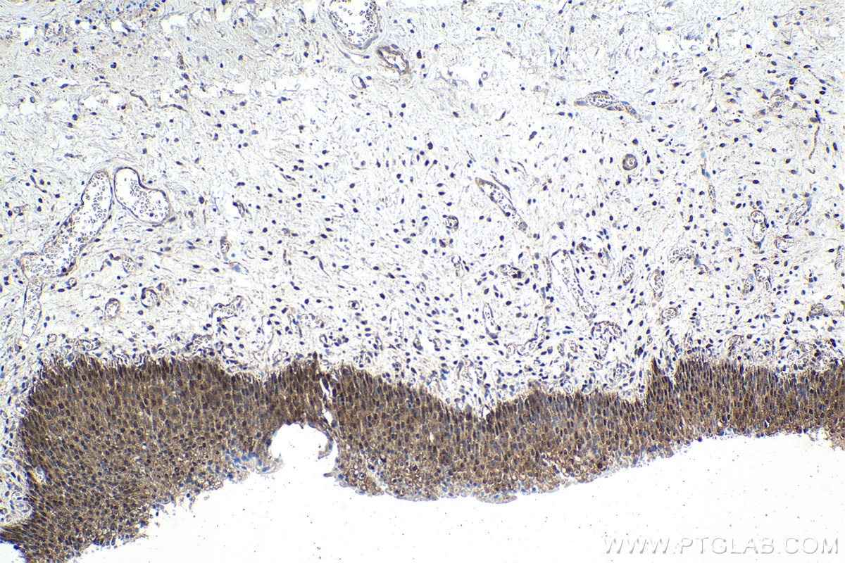 Immunohistochemical analysis of paraffin-embedded human urothelial carcinoma tissue slide using KHC1545 (TFEB IHC Kit).
