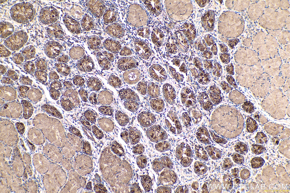Immunohistochemical analysis of paraffin-embedded human stomach cancer tissue slide using KHC0648 (TFF3 IHC Kit).