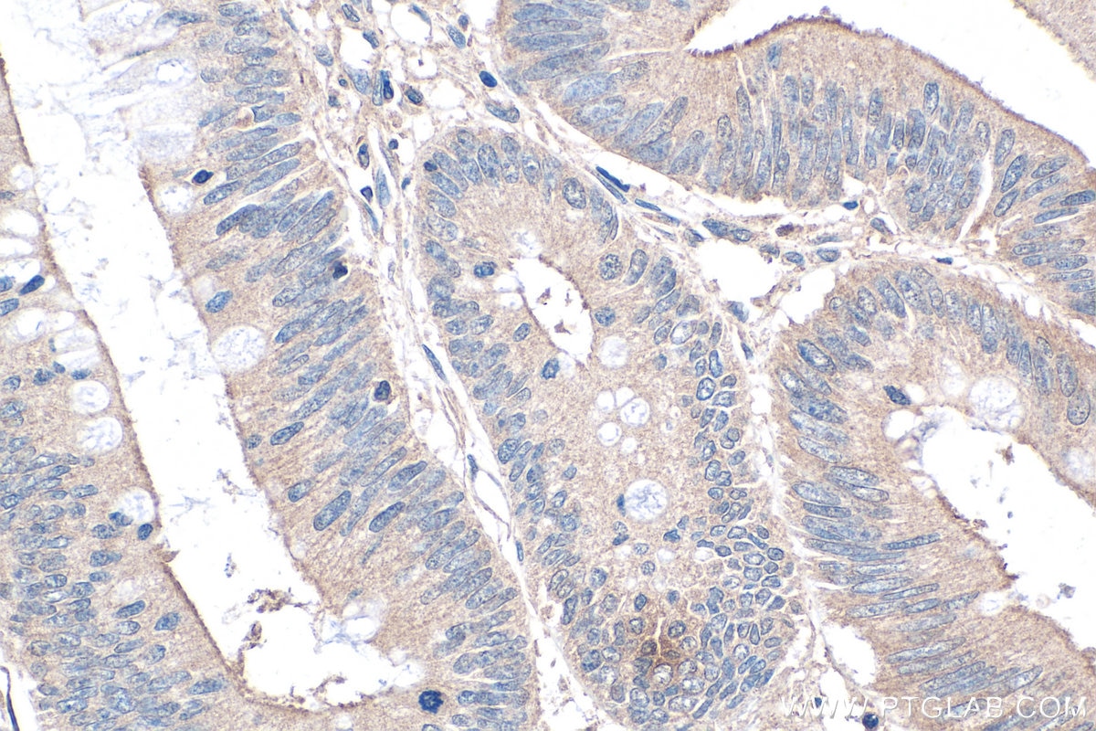 Immunohistochemical analysis of paraffin-embedded human colon cancer tissue slide using KHC0131 (TGF beta 1 IHC Kit).