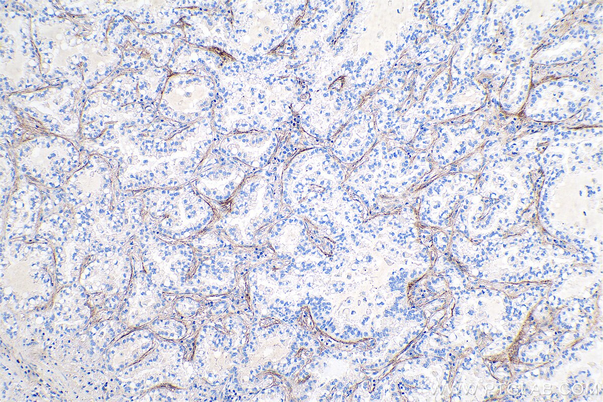Immunohistochemical analysis of paraffin-embedded human lung cancer tissue slide using KHC0729 (TGFBI IHC Kit).