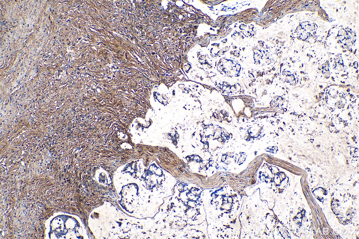 Immunohistochemical analysis of paraffin-embedded human colon cancer tissue slide using KHC0729 (TGFBI IHC Kit).