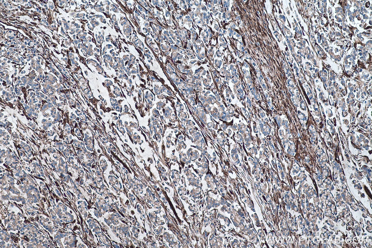 Immunohistochemical analysis of paraffin-embedded human colon cancer tissue slide using KHC0467 (TGM2 IHC Kit).