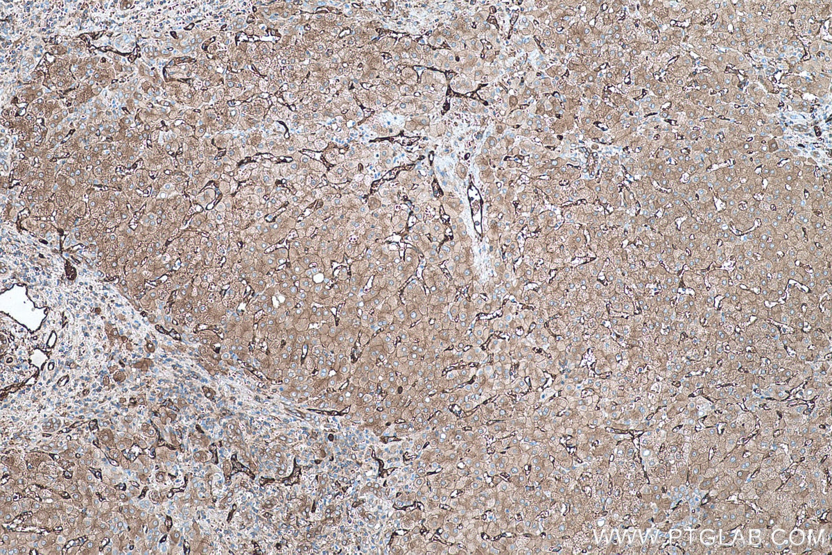 Immunohistochemical analysis of paraffin-embedded human liver cancer tissue slide using KHC0467 (TGM2 IHC Kit).