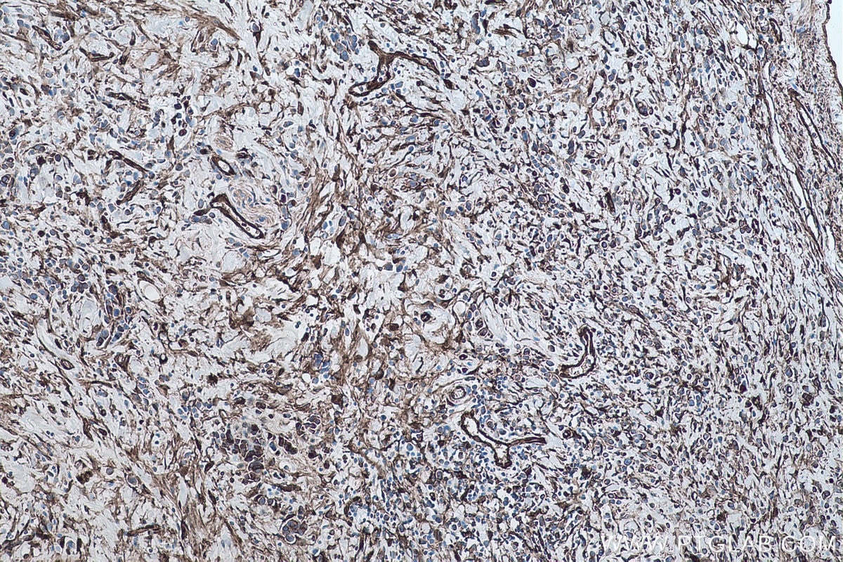 Immunohistochemical analysis of paraffin-embedded human stomach cancer tissue slide using KHC0467 (TGM2 IHC Kit).