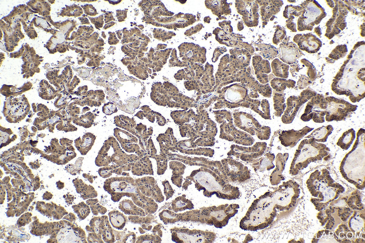 Immunohistochemical analysis of paraffin-embedded human thyroid cancer tissue slide using KHC1870 (THAP11 IHC Kit).