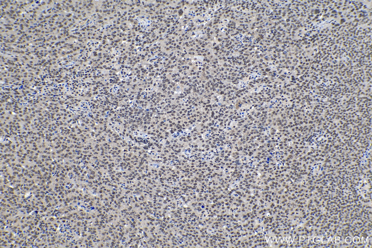 Immunohistochemical analysis of paraffin-embedded human ovary tumor tissue slide using KHC1300 (THOC1 IHC Kit).