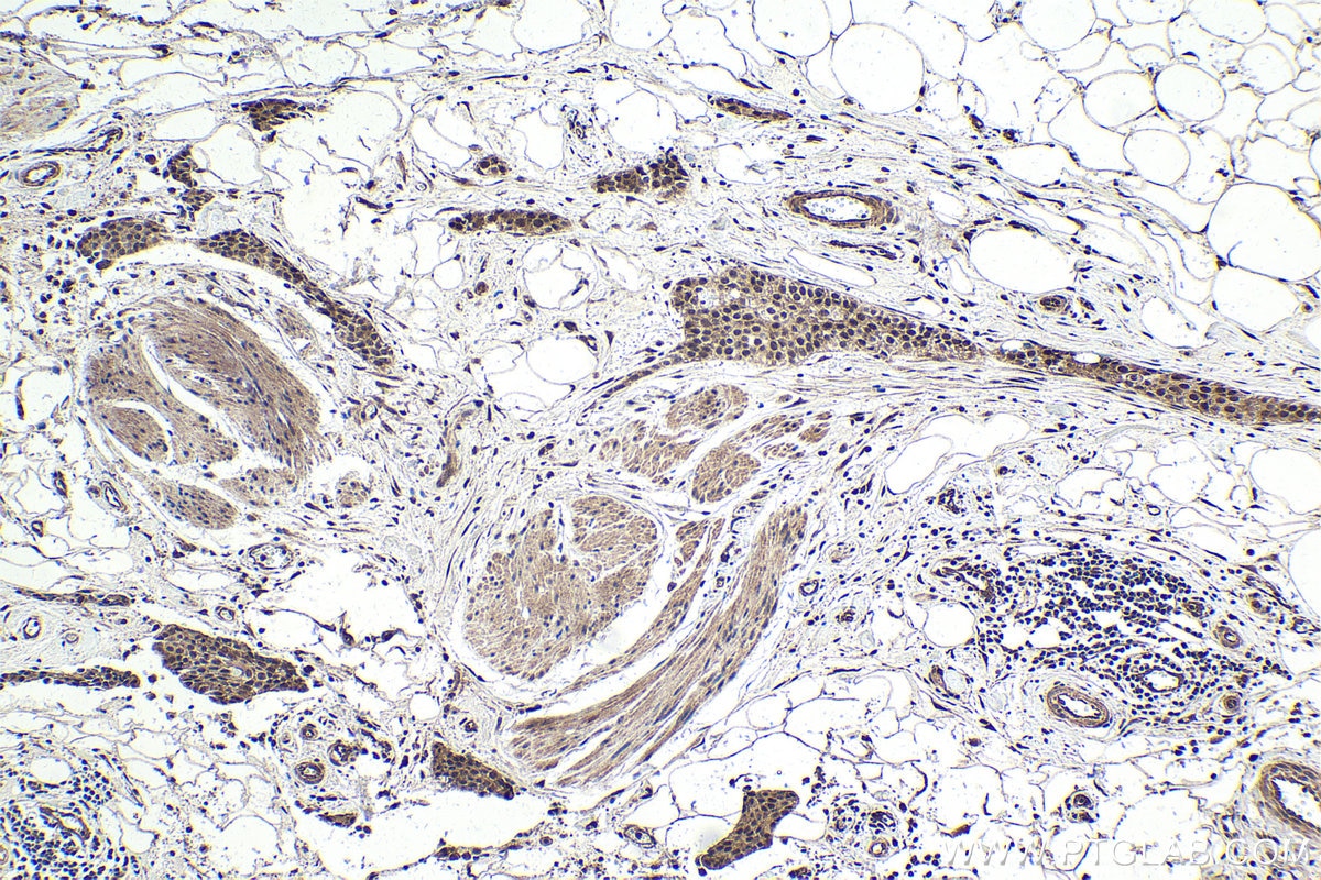 Immunohistochemical analysis of paraffin-embedded human urothelial carcinoma tissue slide using KHC1719 (THOC5 IHC Kit).
