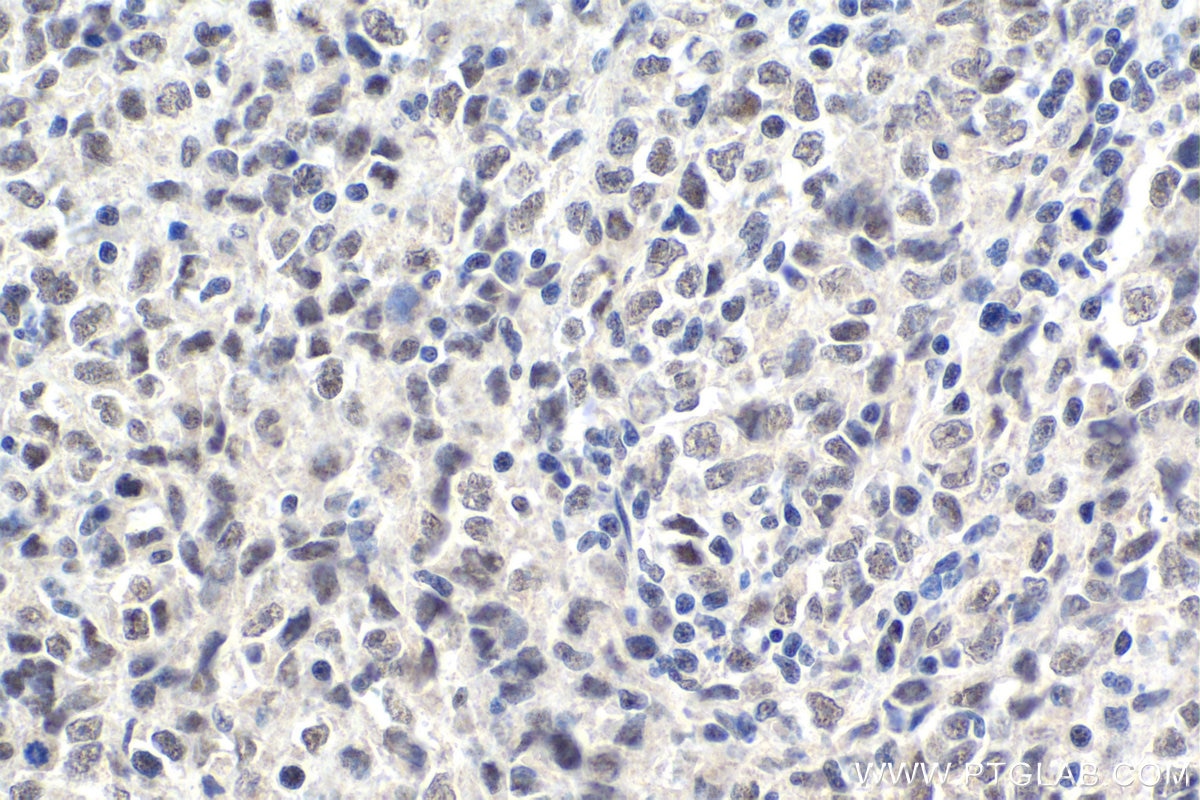 Immunohistochemical analysis of paraffin-embedded human malignant melanoma tissue slide using KHC1719 (THOC5 IHC Kit).