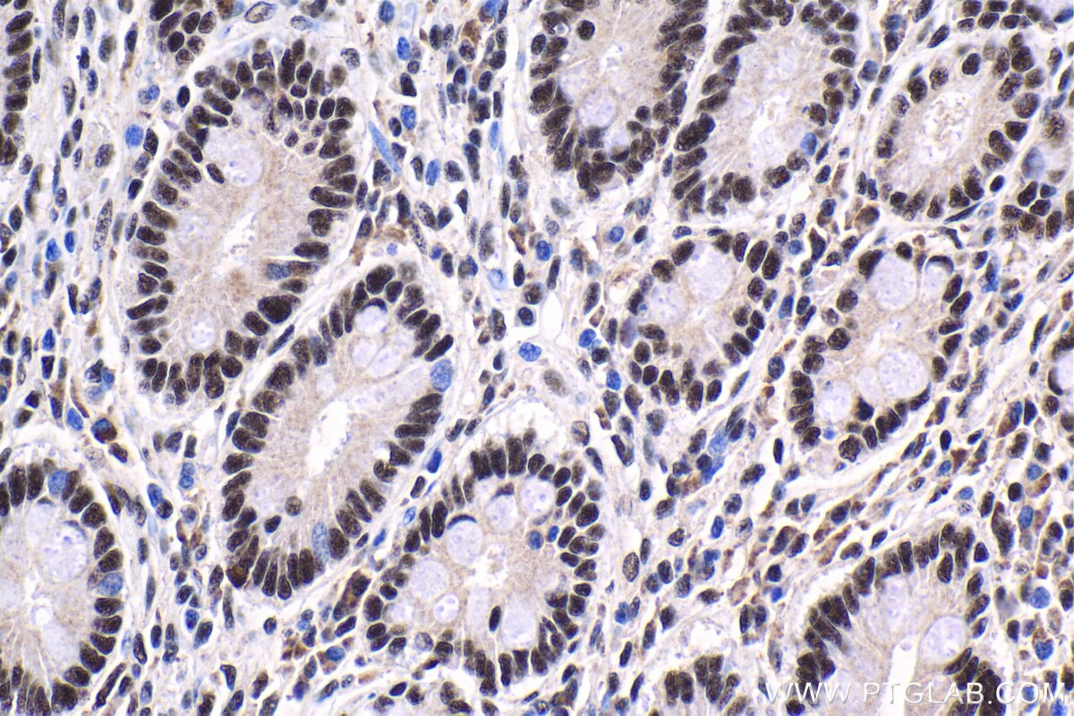 Immunohistochemical analysis of paraffin-embedded human stomach cancer tissue slide using KHC1786 (THOC7 IHC Kit).