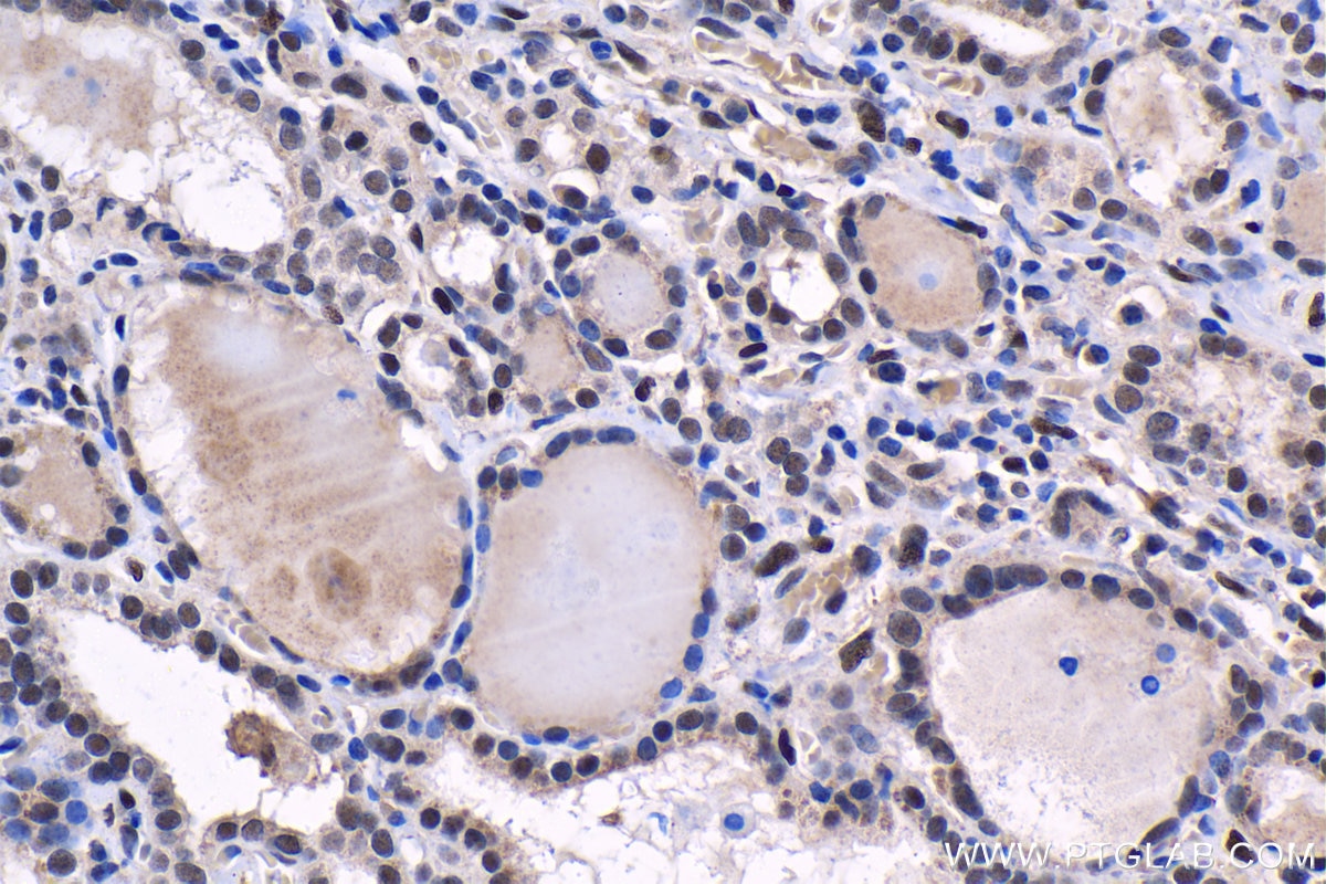 Immunohistochemical analysis of paraffin-embedded human thyroid cancer tissue slide using KHC1523 (THRA IHC Kit).