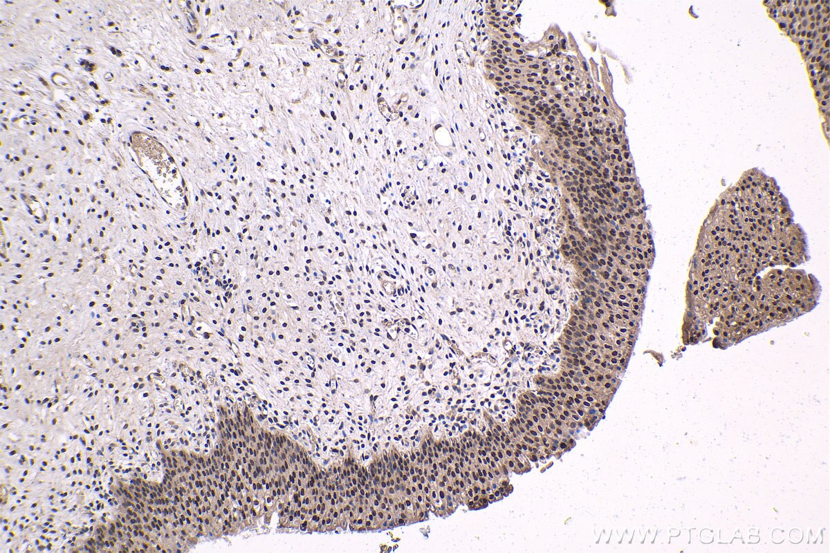 Immunohistochemical analysis of paraffin-embedded human urothelial carcinoma tissue slide using KHC1523 (THRA IHC Kit).