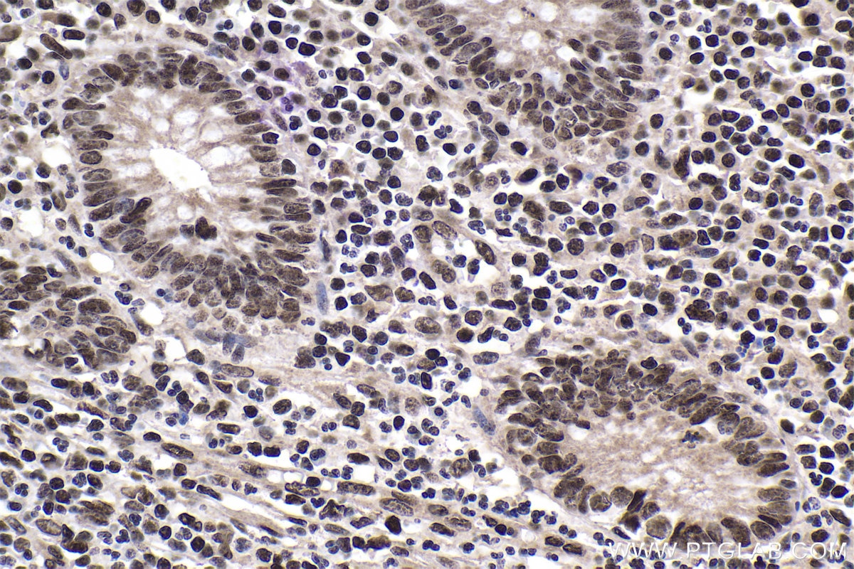 Immunohistochemical analysis of paraffin-embedded human appendicitis tissue slide using KHC1043 (THRAP3 IHC Kit).