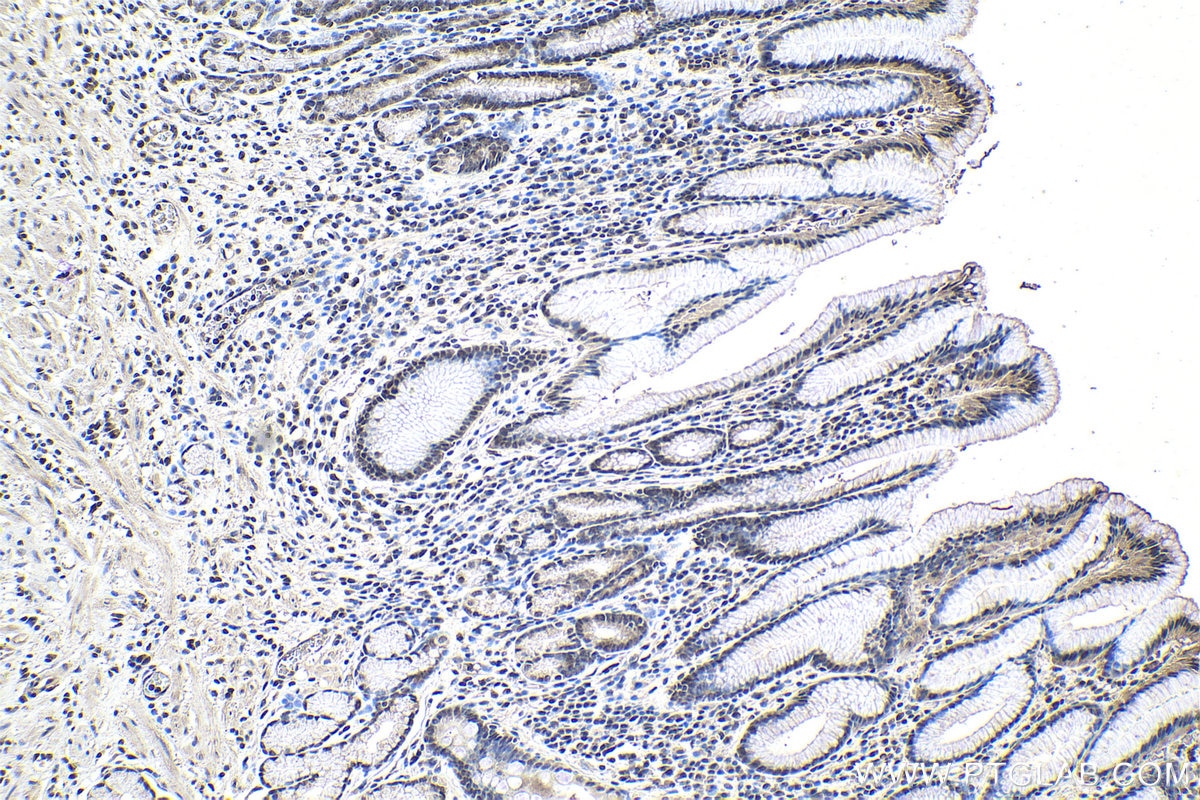 Immunohistochemical analysis of paraffin-embedded human stomach cancer tissue slide using KHC1043 (THRAP3 IHC Kit).