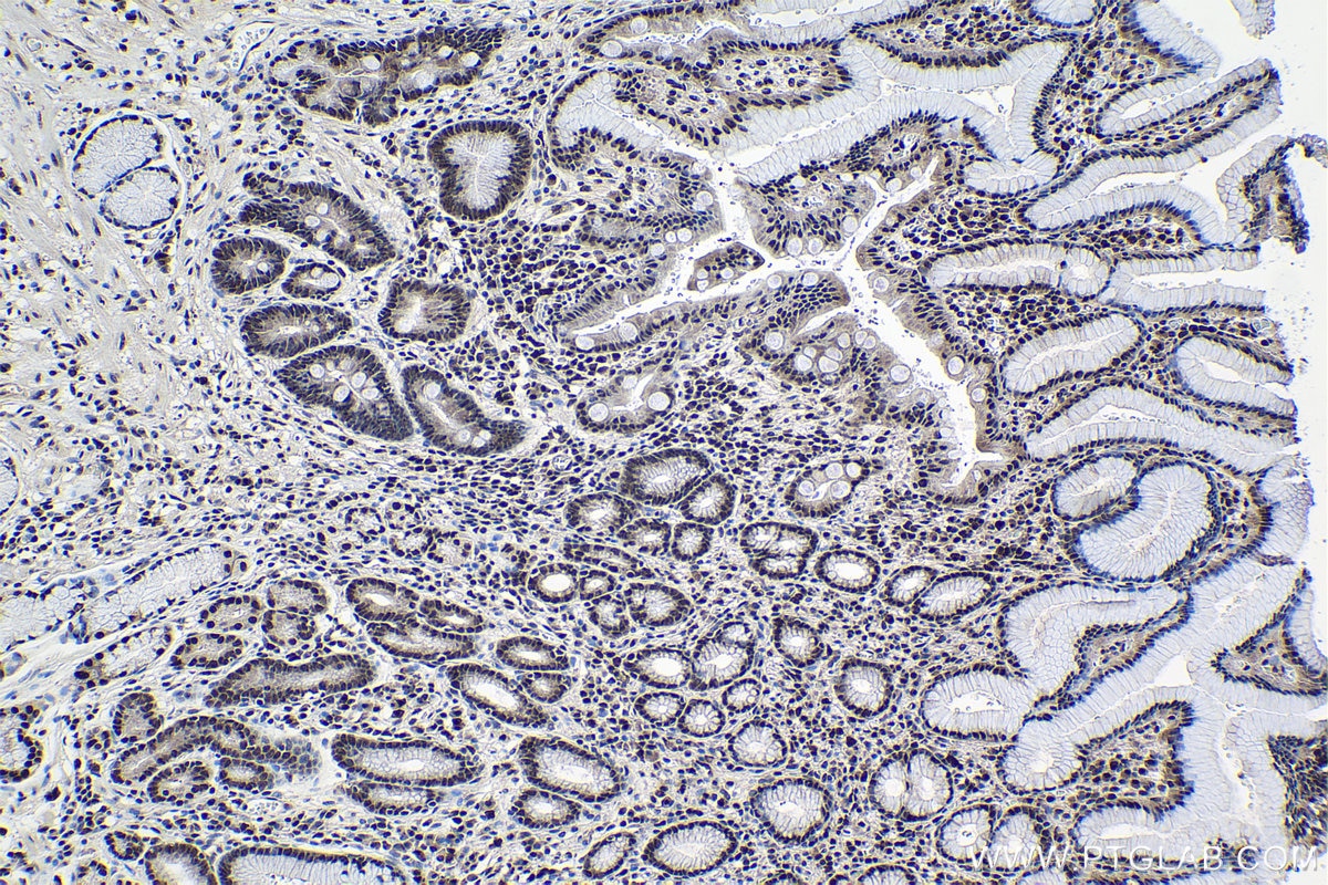 Immunohistochemical analysis of paraffin-embedded human stomach cancer tissue slide using KHC0978 (THUMPD1 IHC Kit).