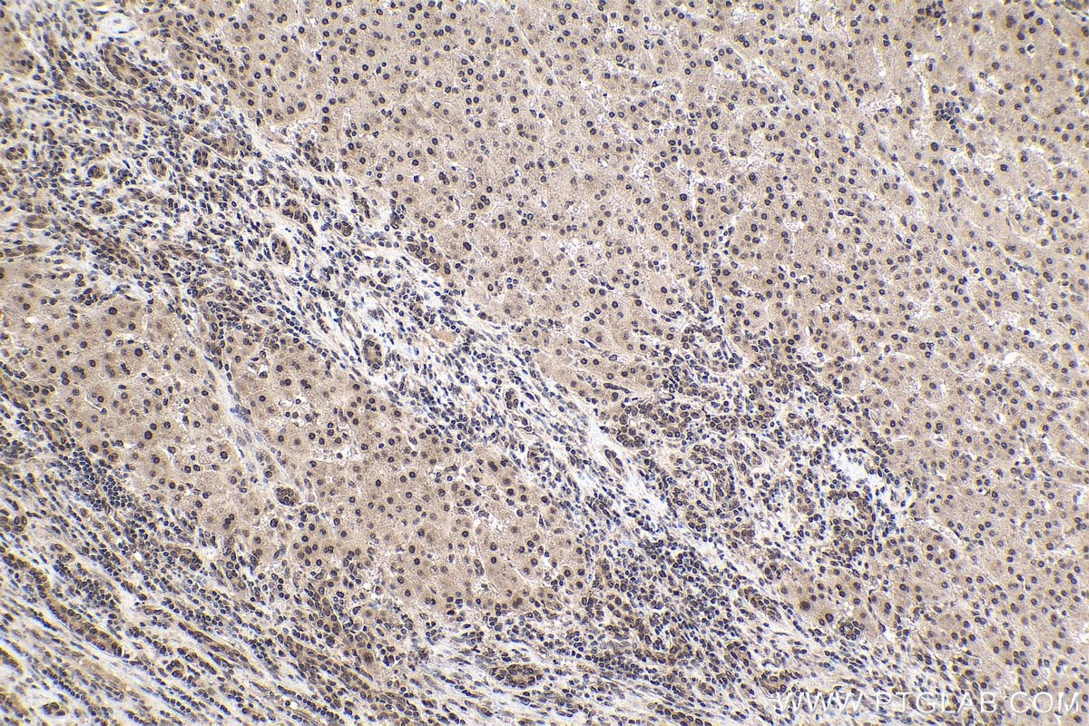 Immunohistochemical analysis of paraffin-embedded human liver cancer tissue slide using KHC1578 (TIA1 IHC Kit).